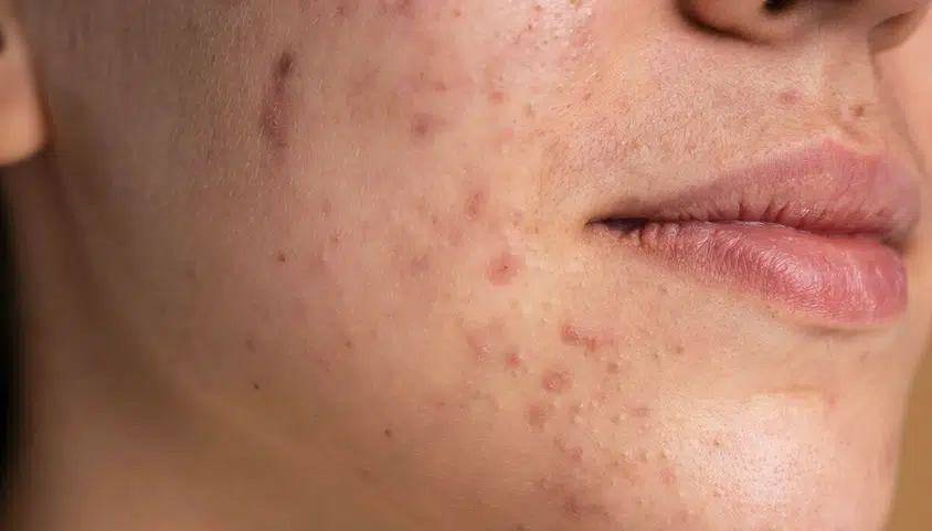 Aknės gydymas accutane kremu