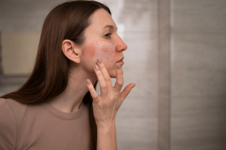 perioralinio dermatito gydymas